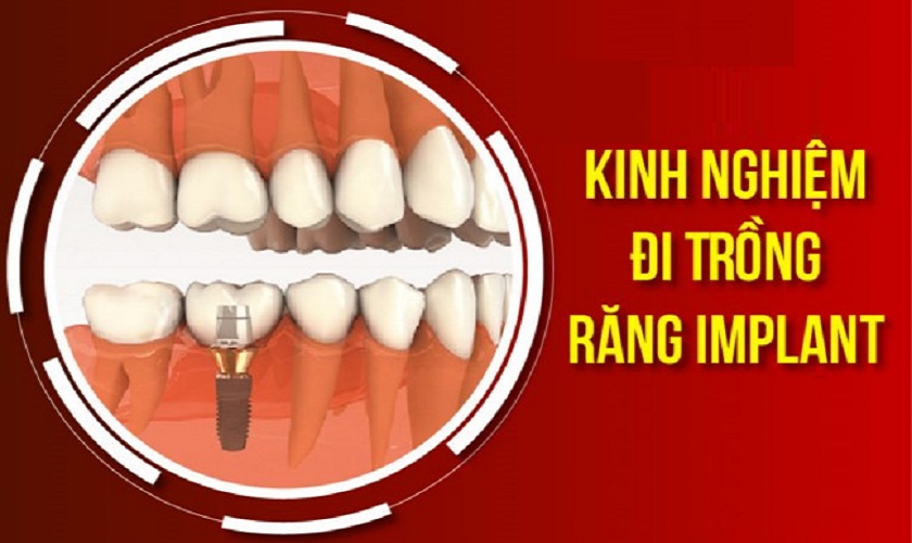Tổng hợp kinh nghiệm đi trồng răng Implant bạn cần biết