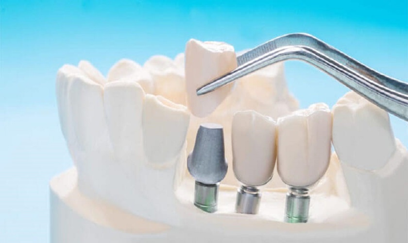 TP HCM - trồng răng Implant ở đâu tốt nhất?