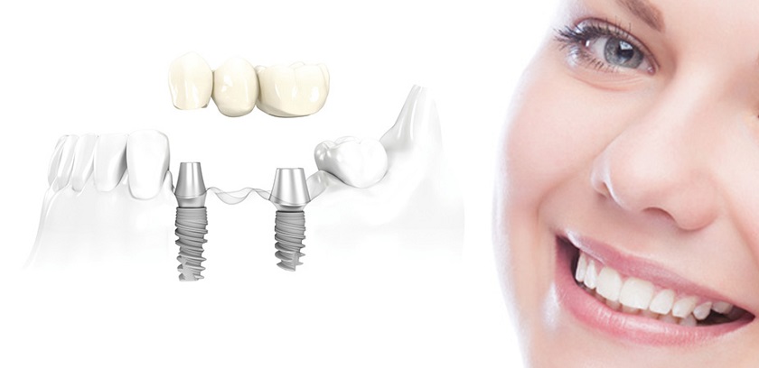Trồng răng Implant để có nụ cười tỏa sáng
