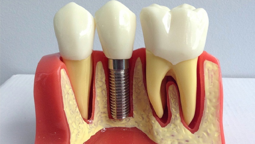 Trồng 1 răng Implant giá bao nhiêu phụ thuộc vào nhiều yếu tố