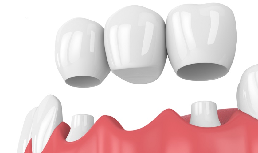 Trồng răng bằng cầu răng sứ có mấy loại? Ưu điểm là gì?