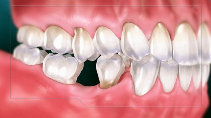 Số răng bị mất cũng ảnh hưởng tới cảm giác đau khi trồng răng Implant