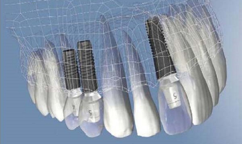 Trồng răng bằng phương pháp Implant có đau không?