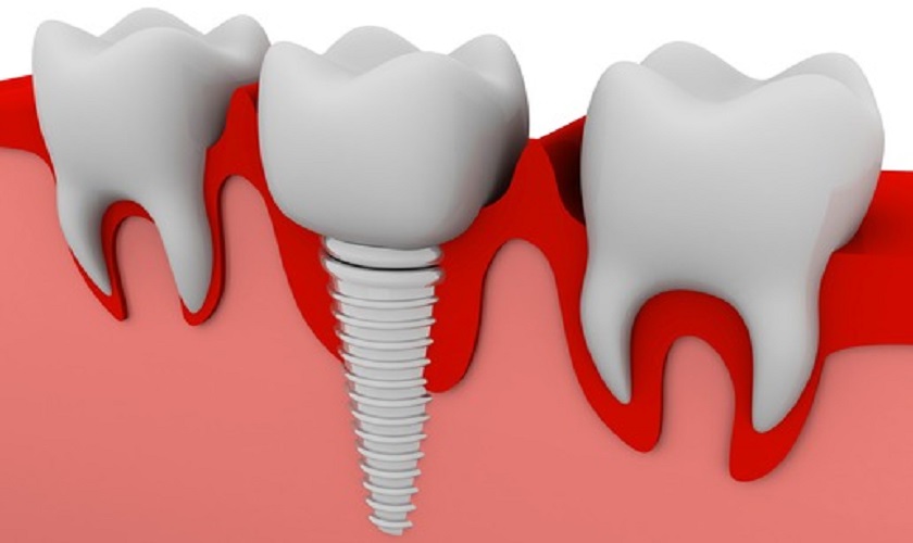  Trồng răng giả Implant giá bao nhiêu?