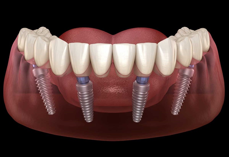 Trồng răng implant all on 4