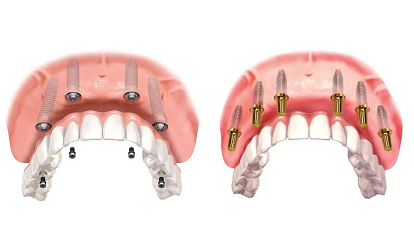 Đối tượng có thể sử dụng kỹ thuật trồng răng Implant All On 6