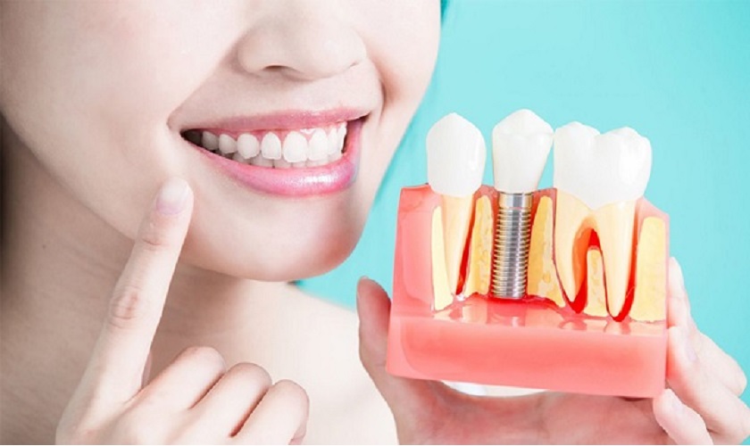 Trồng răng Implant bao lâu thì ăn được? Ăn gì và kiêng gì?