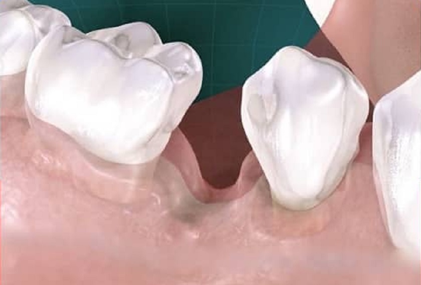 Tình trạng tiêu xương răng