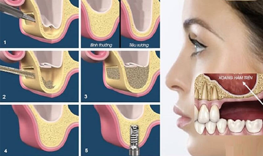 Chữa trị tiêu xương răng bằng cách nâng xoang hàm