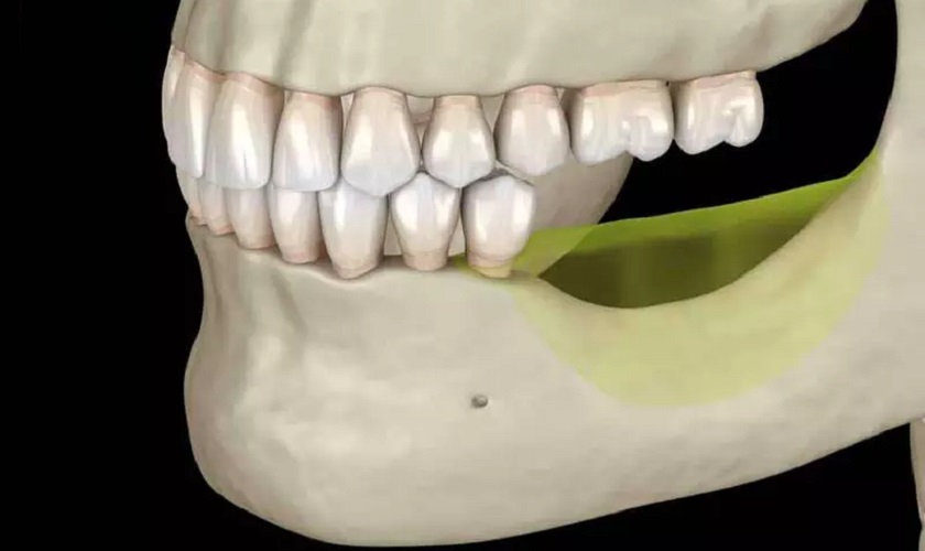 Tiêu xương răng có nguy hiểm hay không?
