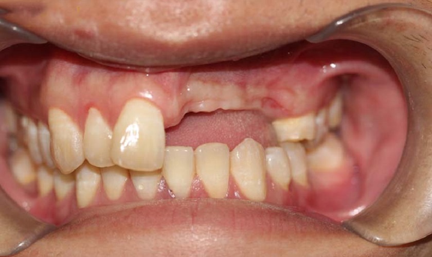 Người bị mất răng lâu năm vẫn có thể cấy ghép Implant