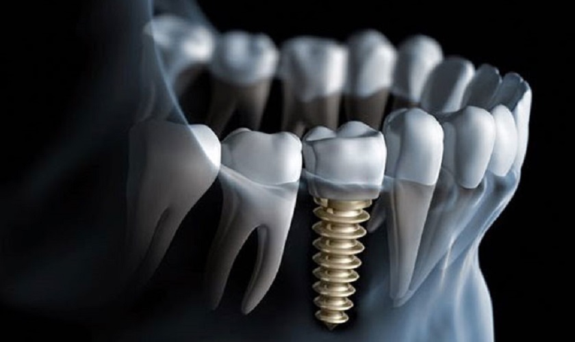 Xương hàm cần đảm bảo tiêu chí về số lượng và chất lượng để cắm Implant