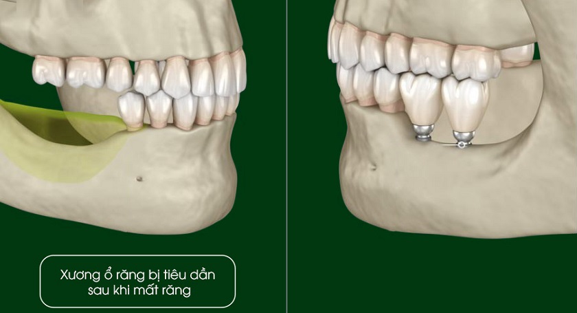 Trồng răng Implant khắc phục tiêu xương răng