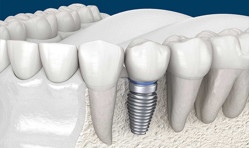 Răng bị tiêu xương có trồng Implant được không?