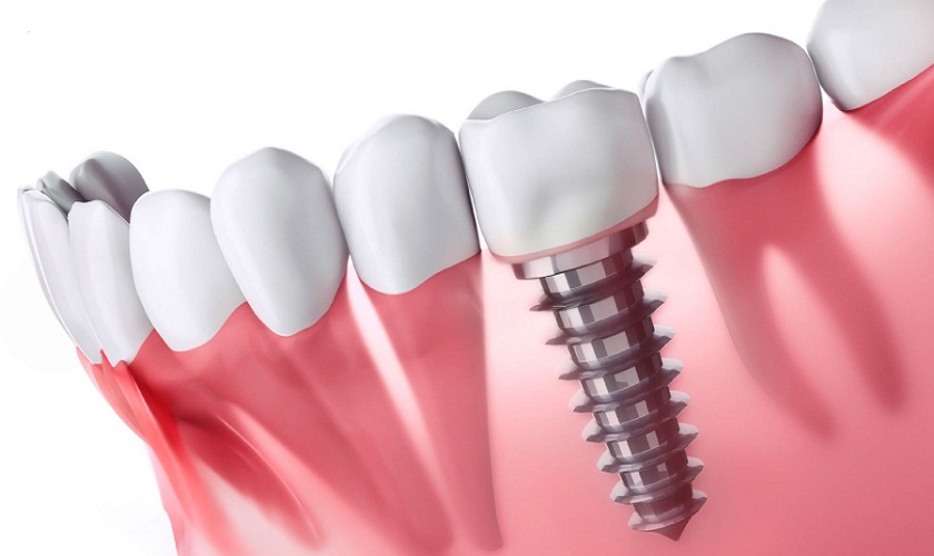 Phục hình răng mất bằng kỹ thuật trồng răng Implant