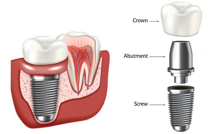 Răng Implant giúp khôi phục toàn diện răng đã mất nhờ cấu trúc tương tự răng thật