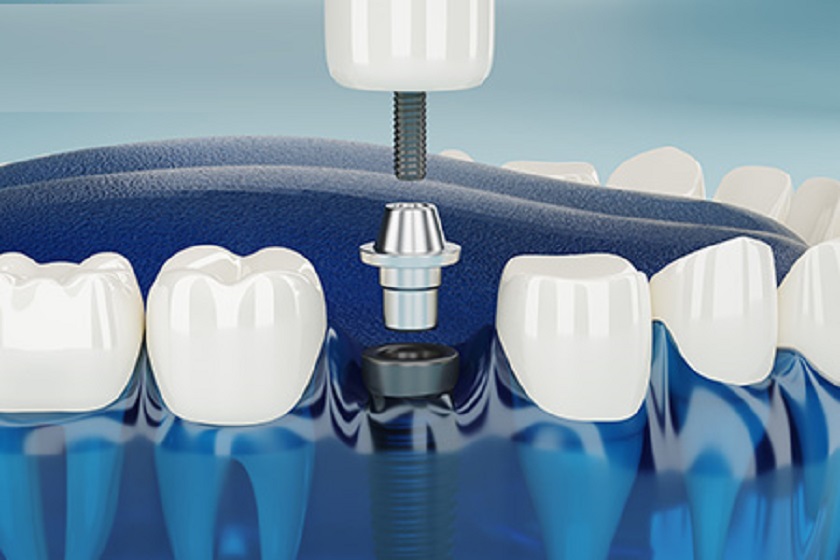 Quá trình cấy ghép Implant không gây ảnh hưởng đến răng khác