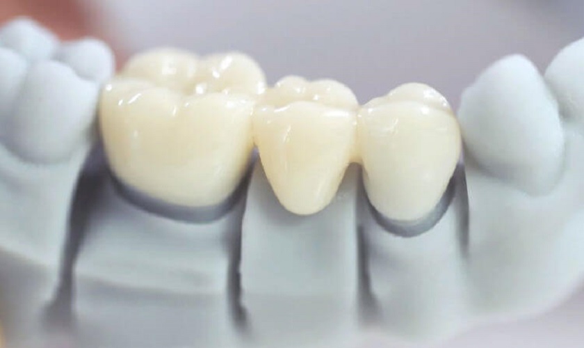 Cầu răng sứ có thể khôi phục lại thân răng đã mất