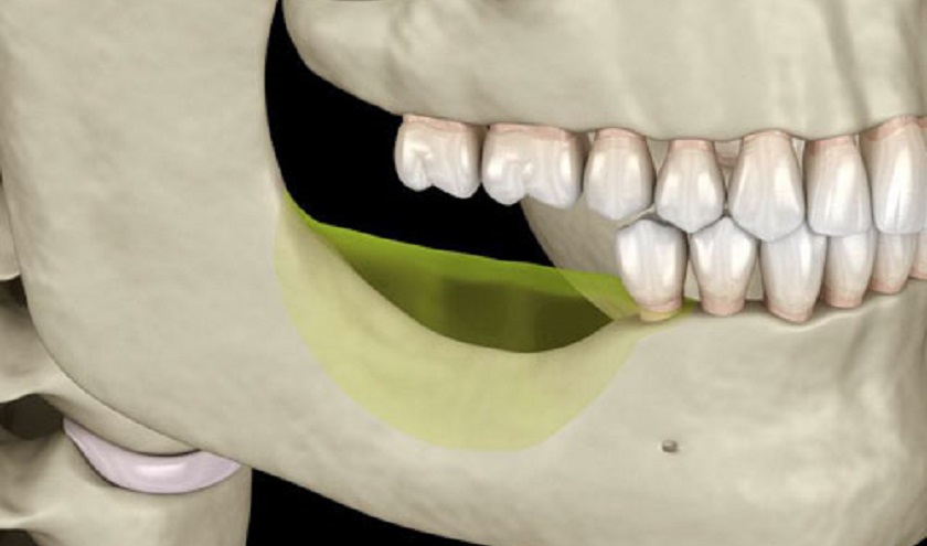 Cầu răng sứ không ngăn chặn được biến chứng tiêu xương