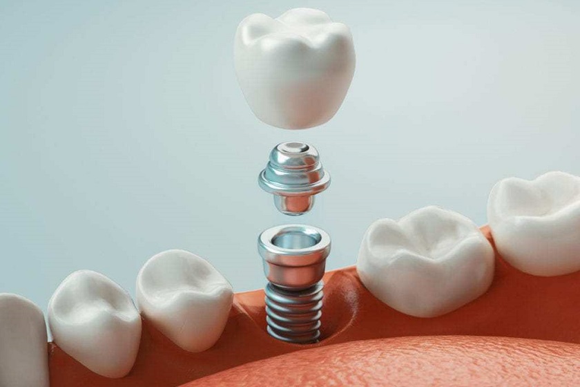 Răng sứ trên Implant cũng là yếu tố ảnh hưởng tới chi phí cấy ghép