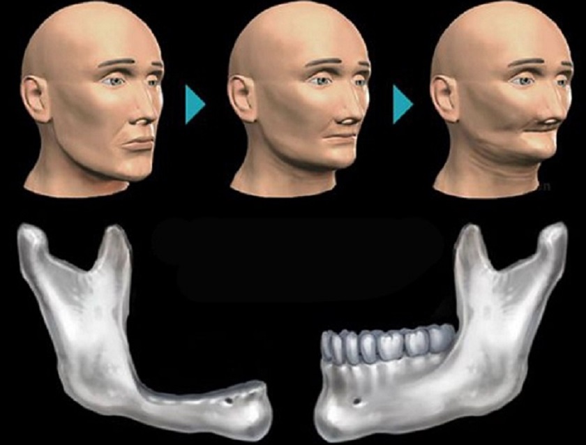 Mất răng gây ra hiện tượng tiêu xương hàm