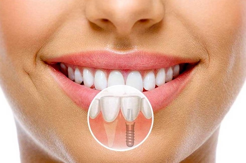 Răng Implant là sản phẩm răng giả mang giá trị thẩm mỹ cao nhất hiện nay