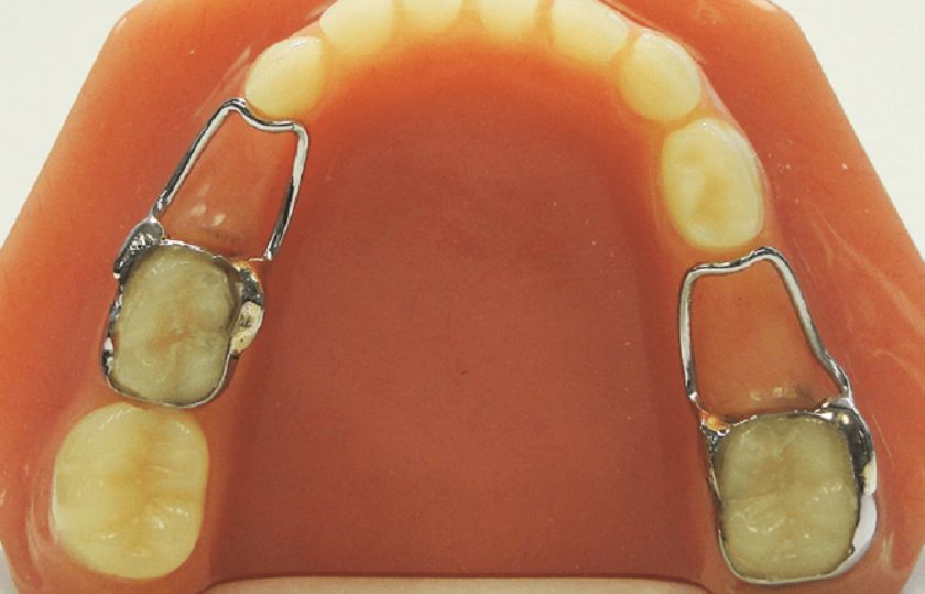 Trẻ bị mất răng sớm phù hợp với phương pháp nào