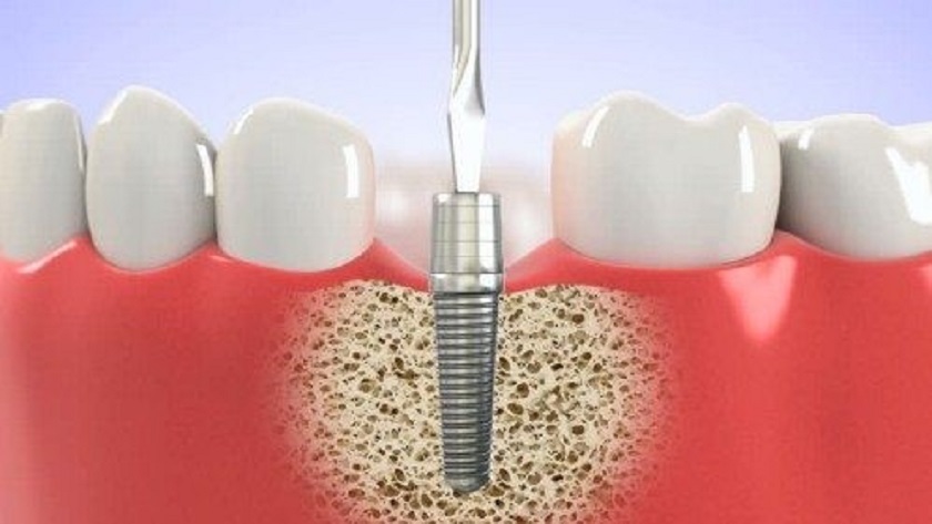 Cấy ghép trụ Implant tại vị trí răng đã mất để khôi phục chân răng