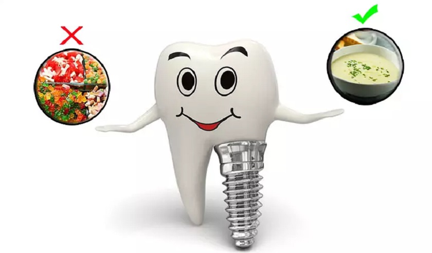Trồng răng Implant nên ăn gì và kiêng gì?