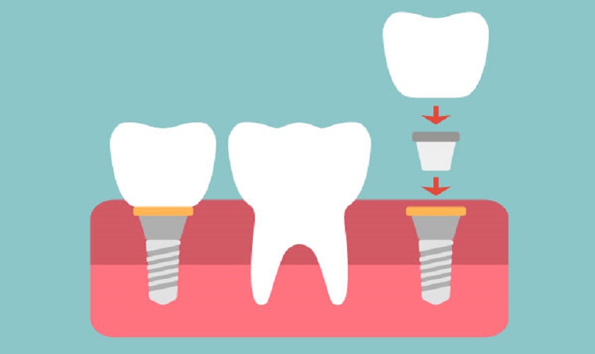 Trụ Implant được cấy trực tiếp vào xương hàm giúp răng giả chắc chắn như răng tự nhiên