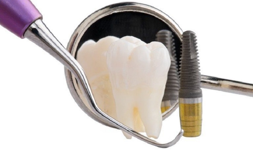 Trồng răng Implant có bền không? Thời gian sử dụng được bao lâu?