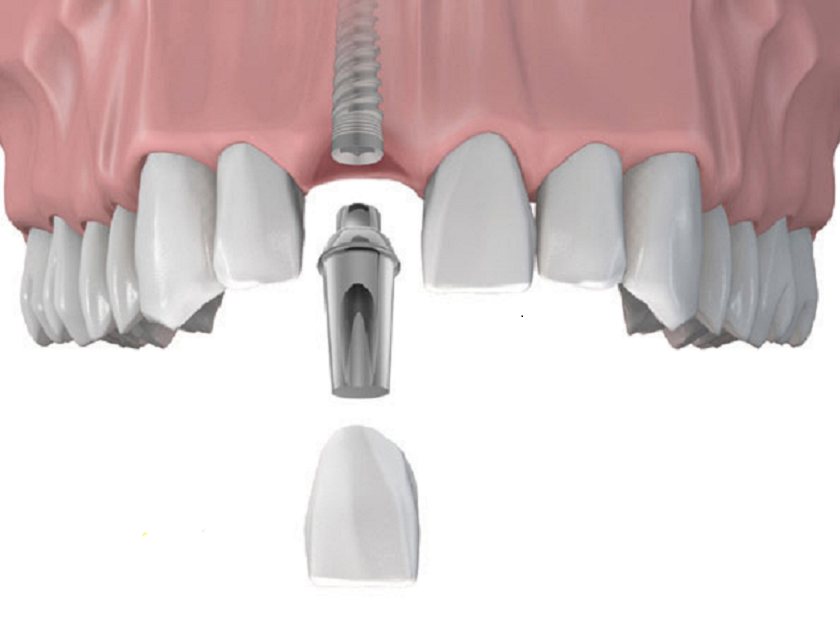 Những yếu tố quyết định một ca trồng răng Implant có đau hay không