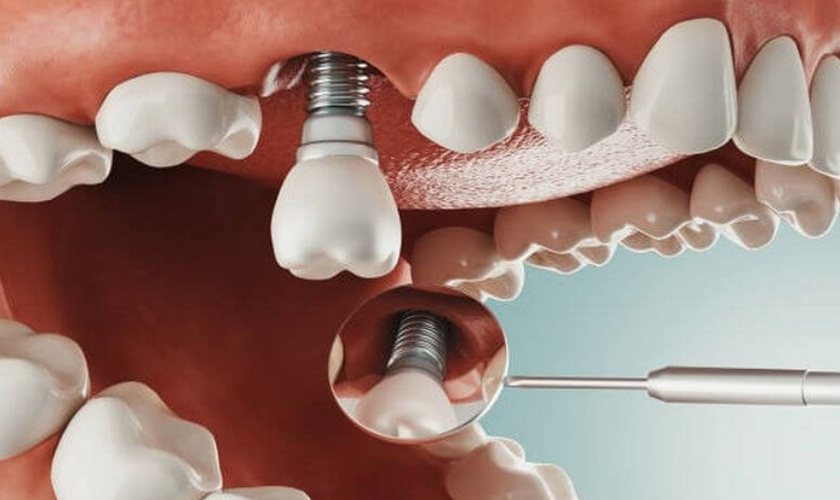Trồng răng Implant có đau không? Kiến thức chuyên gia