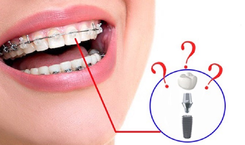 Trồng Implant có niềng răng được không?