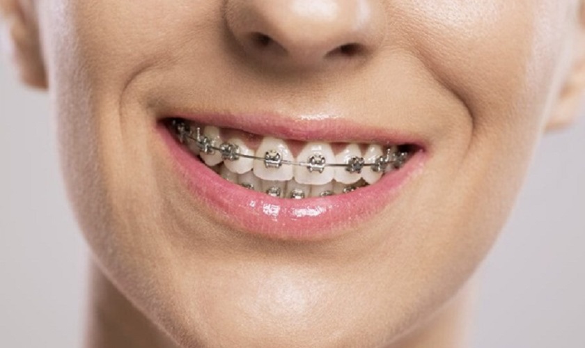 Các bác sĩ thường khuyên khách hàng nên niềng răng trước khi cấy Implant