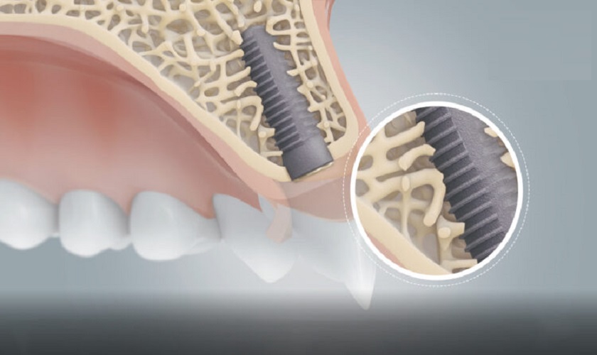 Độ vững chắc của răng Implant đến từ sự tích hợp giữa trụ chân răng và xương hàm nên rất khó dịch chuyển