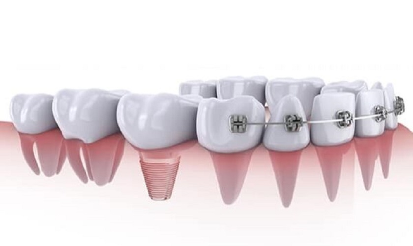 Niềng răng Implant có thể được thực hiện khi quá trình nắn chỉnh không gây tác động tới răng Implant