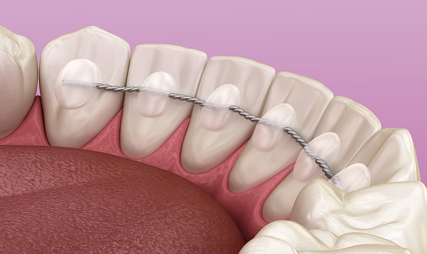 Cần đeo hàm duy trì để răng ổn định trở lại sau khi tháo niềng
