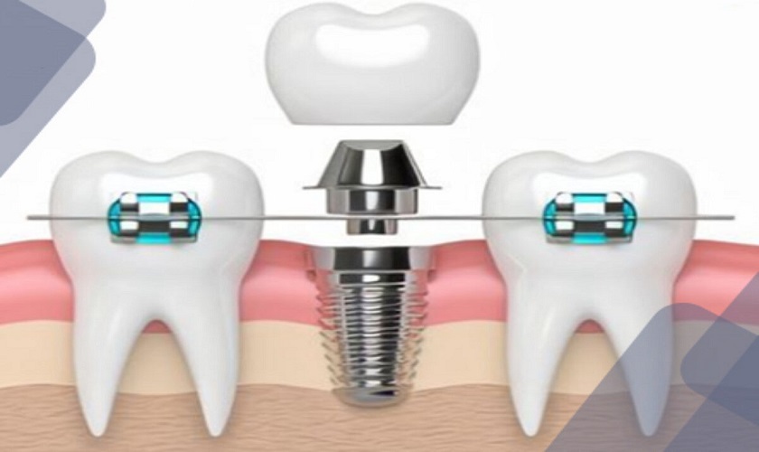 Sau khi trồng răng Implant có niềng răng được không? Vì sao?