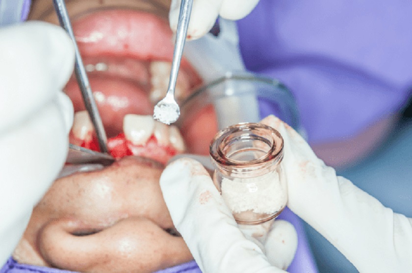 Kỹ thuật ghép xương răng trong cấy ghép Implant