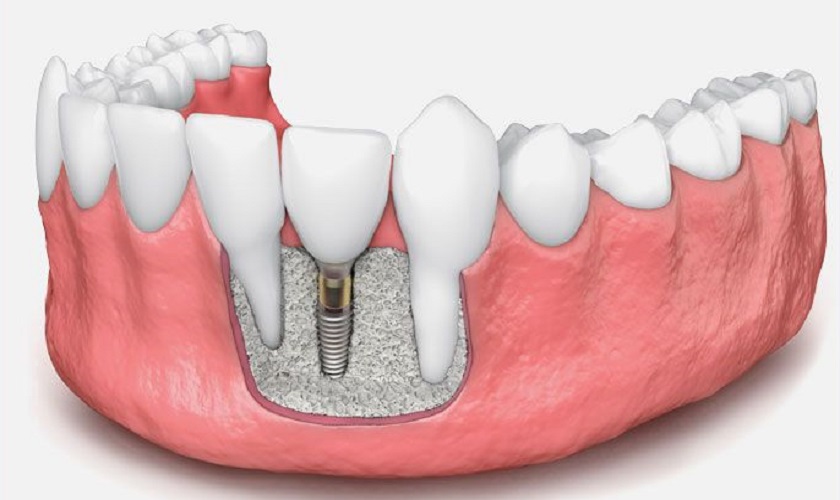Trồng răng Implant ghép xương là gì? Cần thực hiện khi nào?
