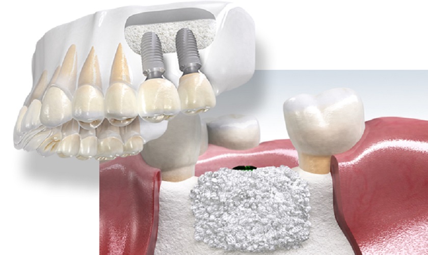 Tìm hiểu về phẫu thuật ghép xương để trồng răng Implant