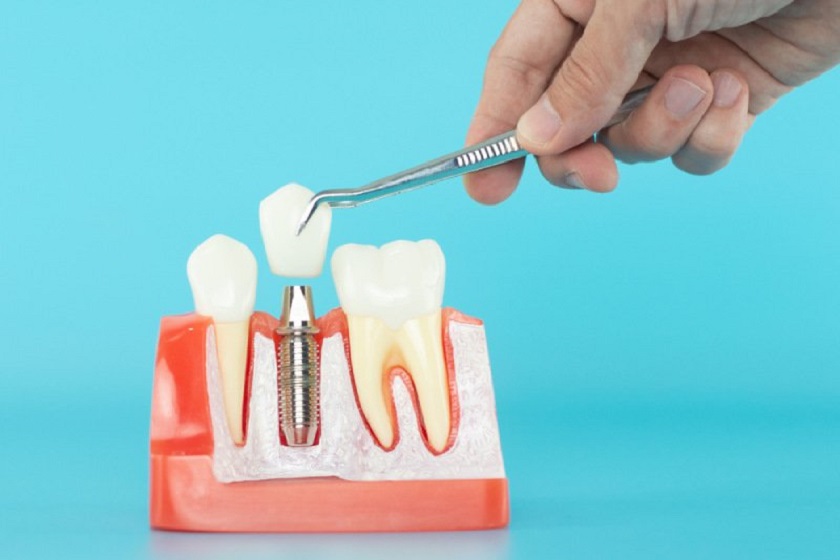 Tại sao giá trồng răng Implant lại cao?