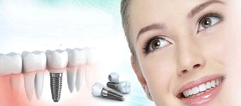 Trồng răng Implant là phương pháp phục hình hiện đại và toàn diện nhất trong nha khoa