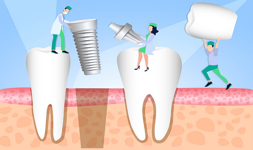 Trồng răng Implant giá cả thế nào? Có tốt không?
