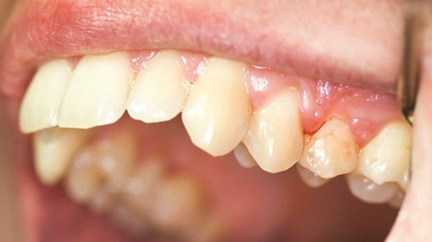 Trồng răng implant giá rẻ dễ gây ra các bệnh lý về răng