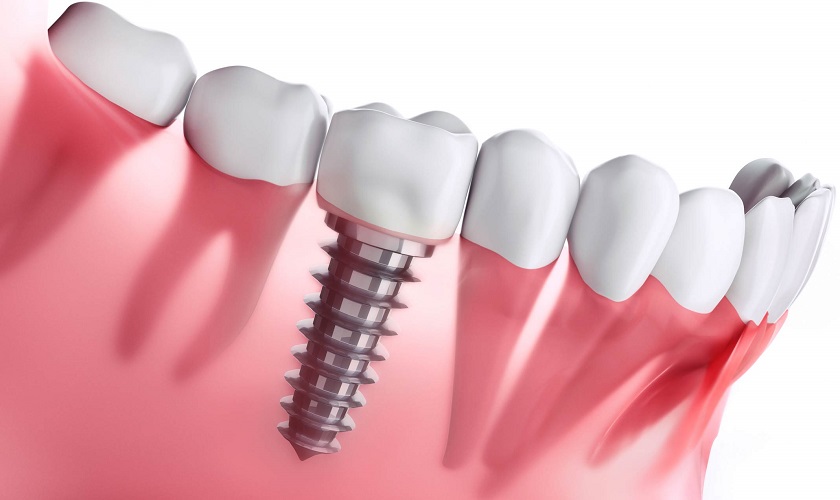 Trồng răng implant giá rẻ có thực sự tốt? Rủi ro đem lại