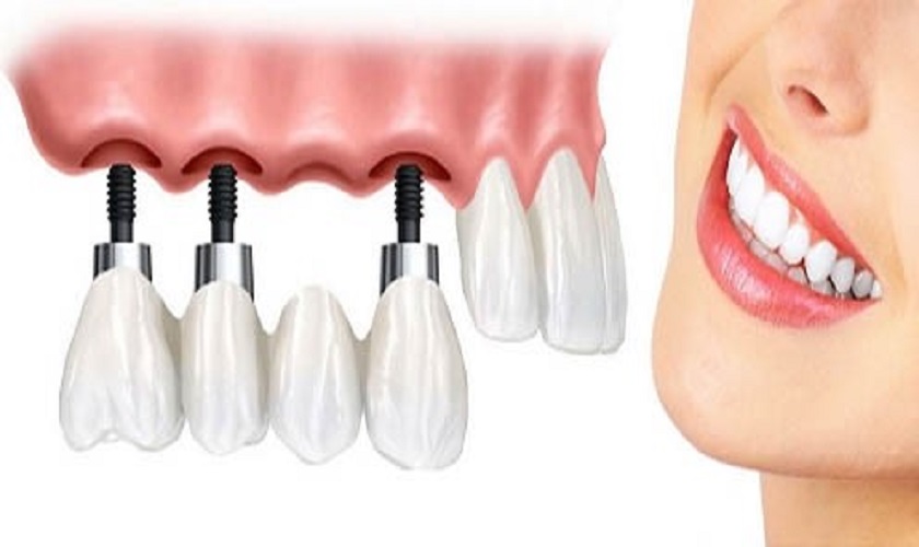 Trồng răng Implant hàm trên bao nhiêu tiền?