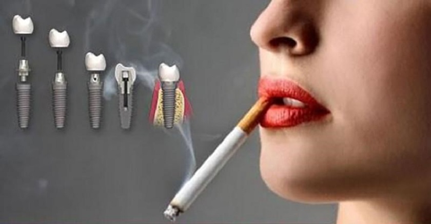 Trồng răng Implant hút thuốc được không?