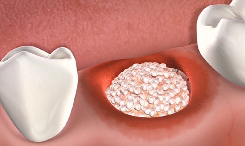 Các chất trong thuốc lá gây ảnh hưởng tới thủ thuật ghép xương răng